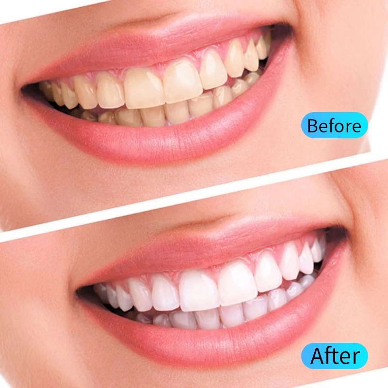 Kit gel sbiancante per denti I - Teeth Whitening Filter recensione e prezzo