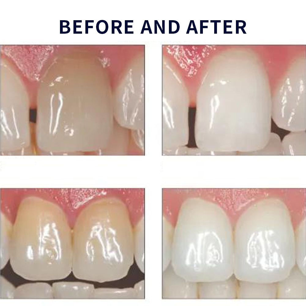 Opalescence Whitening 20% PF 2 - Teeth Whitening Bleaching Kit recensione e prezzo