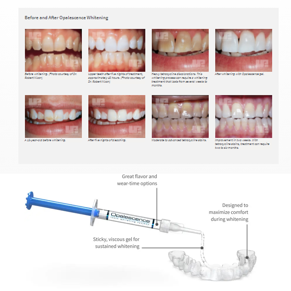 Opalescence Whitening 20% PF 2 - Teeth Whitening Bleaching Kit recensione e prezzo