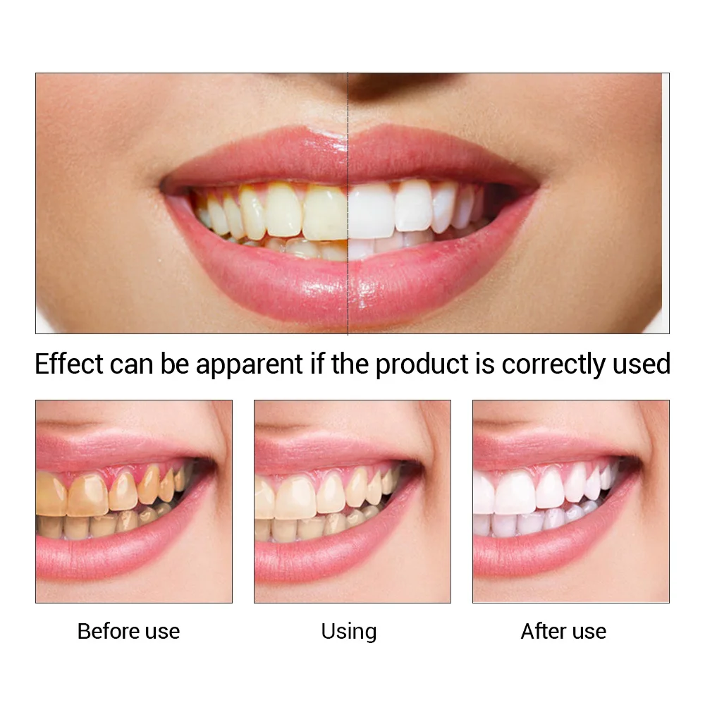 FTEENPLY Sbiancamento Dei Dent - Teeth Whitening App recensione e prezzo
