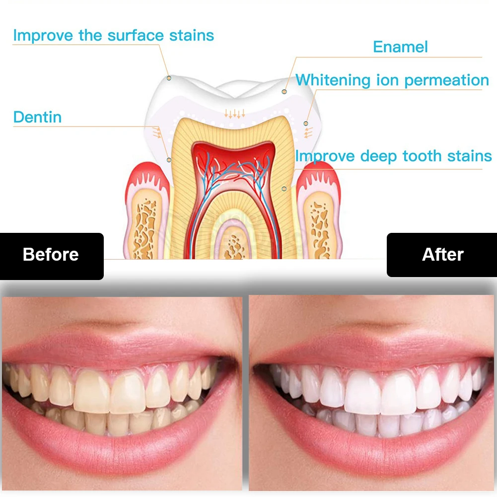 Kit per sbiancamento dei denti - Teeth Whitening App recensione e prezzo